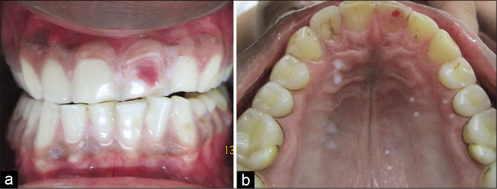 (a) Pink tooth in relation to maxillary left central incisor (labial view). (b) Pink tooth in relation to maxillary left incisor (palatal view).