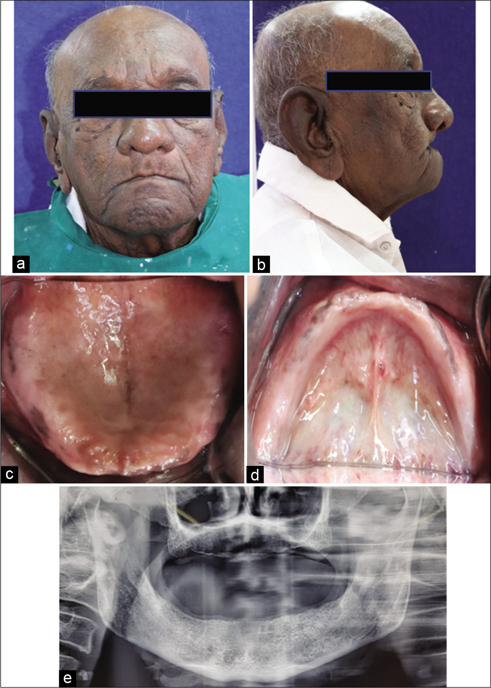 (a) Pre-operative frontal view, (b) Pre-operative lateral view, (c) Intraoral view (Maxilla), (d) Intraoral view (Mandible), (e) OPG of patient.