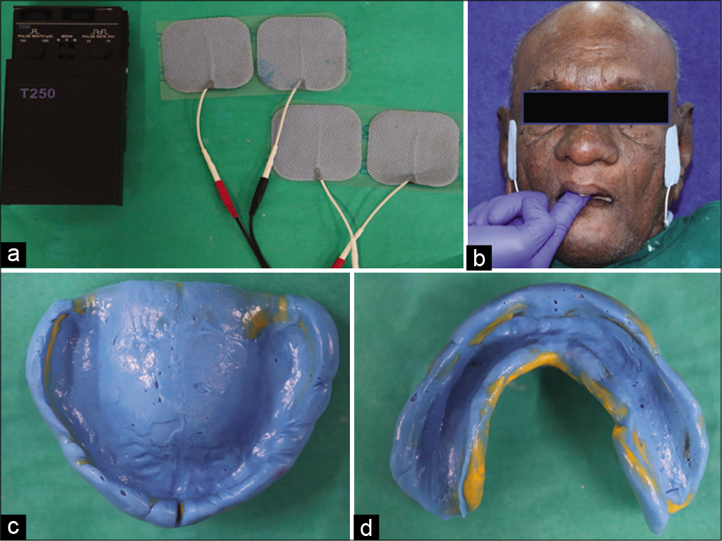 (a) Ultra-low-frequency-transcutaneous electric nerve stimulation (ULF-TENS) apparatus, (b) ULF-TENS application in situ, (c) Maxillary final impression, (d) Mandibular final impression.