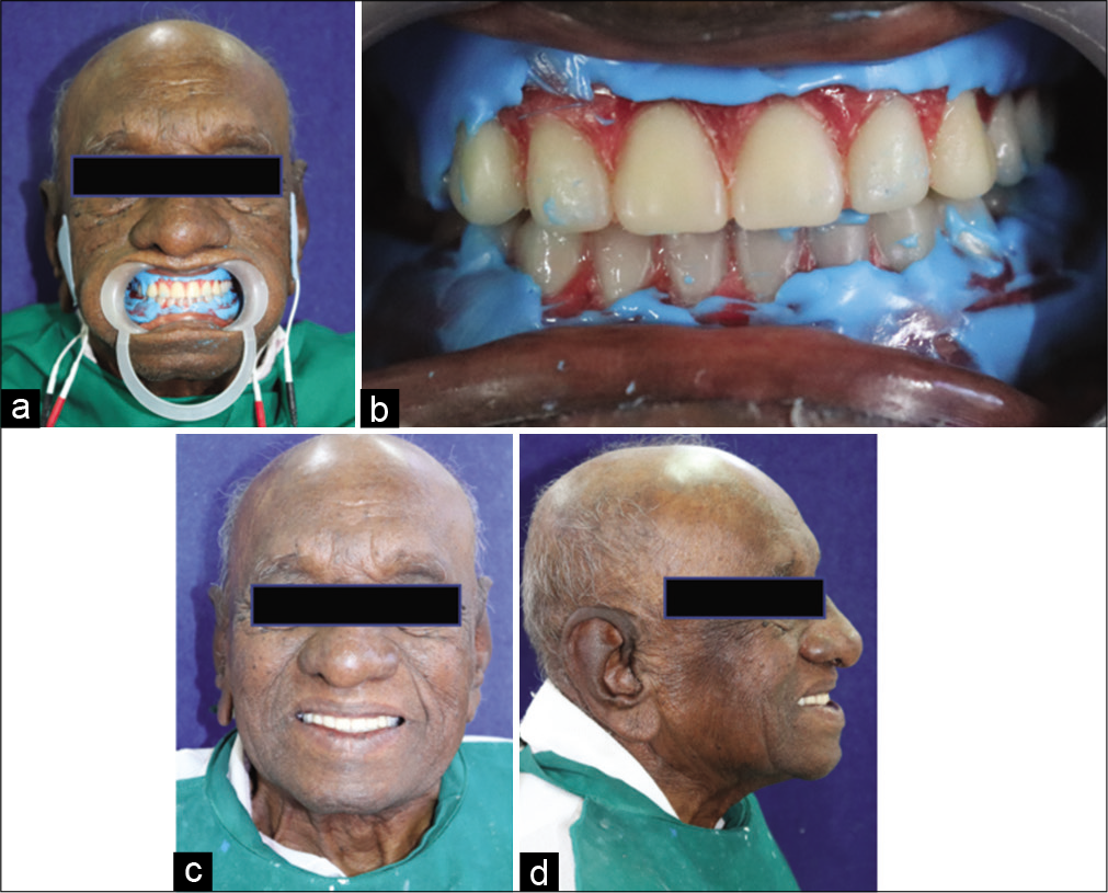 (a) Ultra-low-frequency-transcutaneous electric nerve stimulation application in situ, (b) Intra-oral view, (c) Post-operative frontal view, (d) Post-operative lateral view.