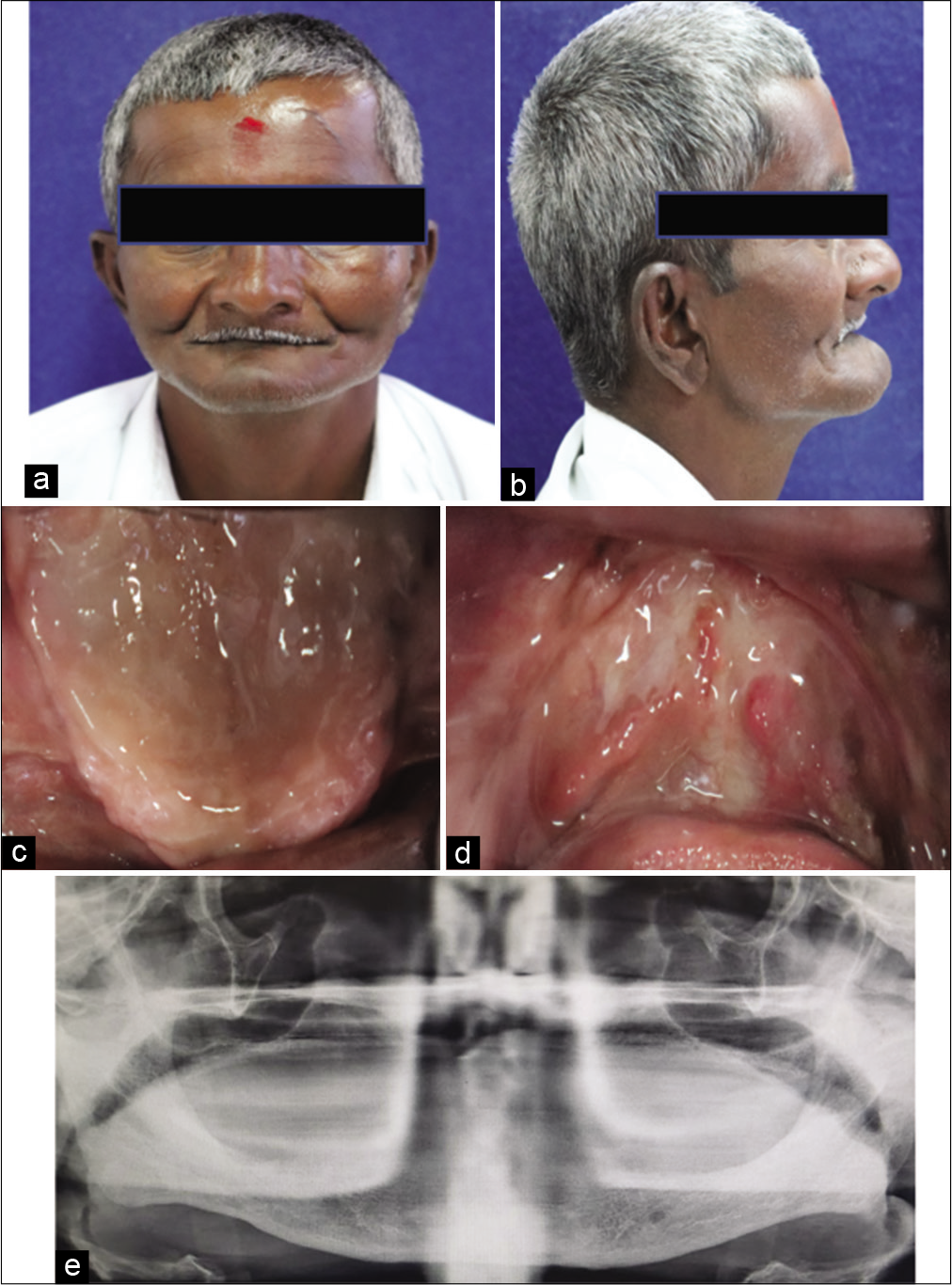 (a) Pre-operative frontal view, (b) Pre-operative lateral view, (c) Intraoral view (Maxilla), (d) Intraoral view (Mandible), (e) OPG of the patient.