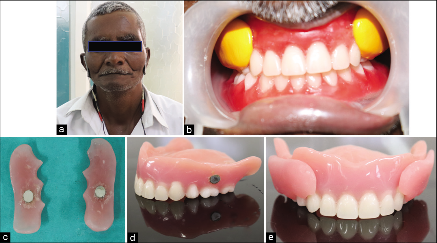 (a) Ultra-low-frequency-transcutaneous electric nerve stimulation application in situ, (b) Recording cheek plumpers, (c and d) Dyna magnetic attachments on cheek plumper and maxillary denture base, (e) Maxillary denture with attached cheek plumpers.