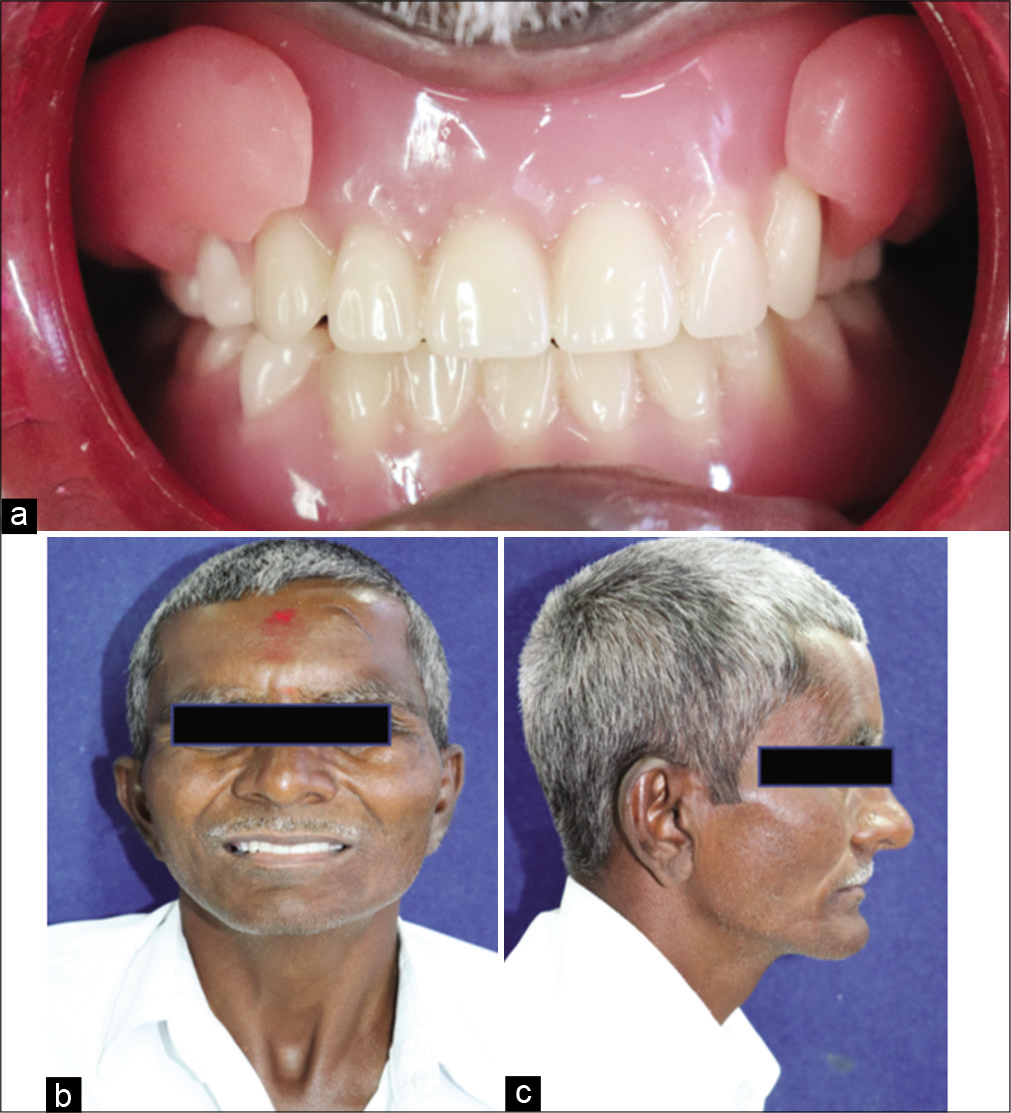 (a) Prosthesis in situ, (b) Post-operative frontal view, (c) Post-operative lateral view.