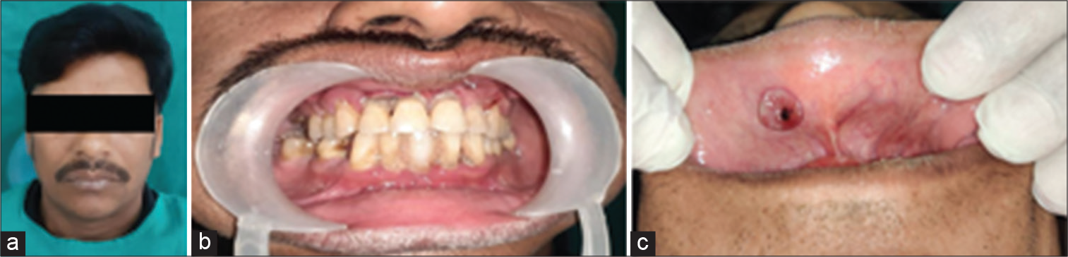 (a) A 40-year-old male with a localized growth in the upper labial mucosa, (b) local foci of irritation, and (c) a solitary exophytic sessile growth was seen on upper labial mucosa.