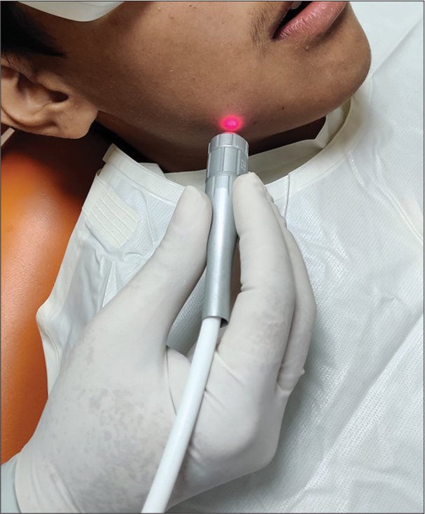 Laser photobiomodulation of antibioma with flat-top R-24 handpiece.