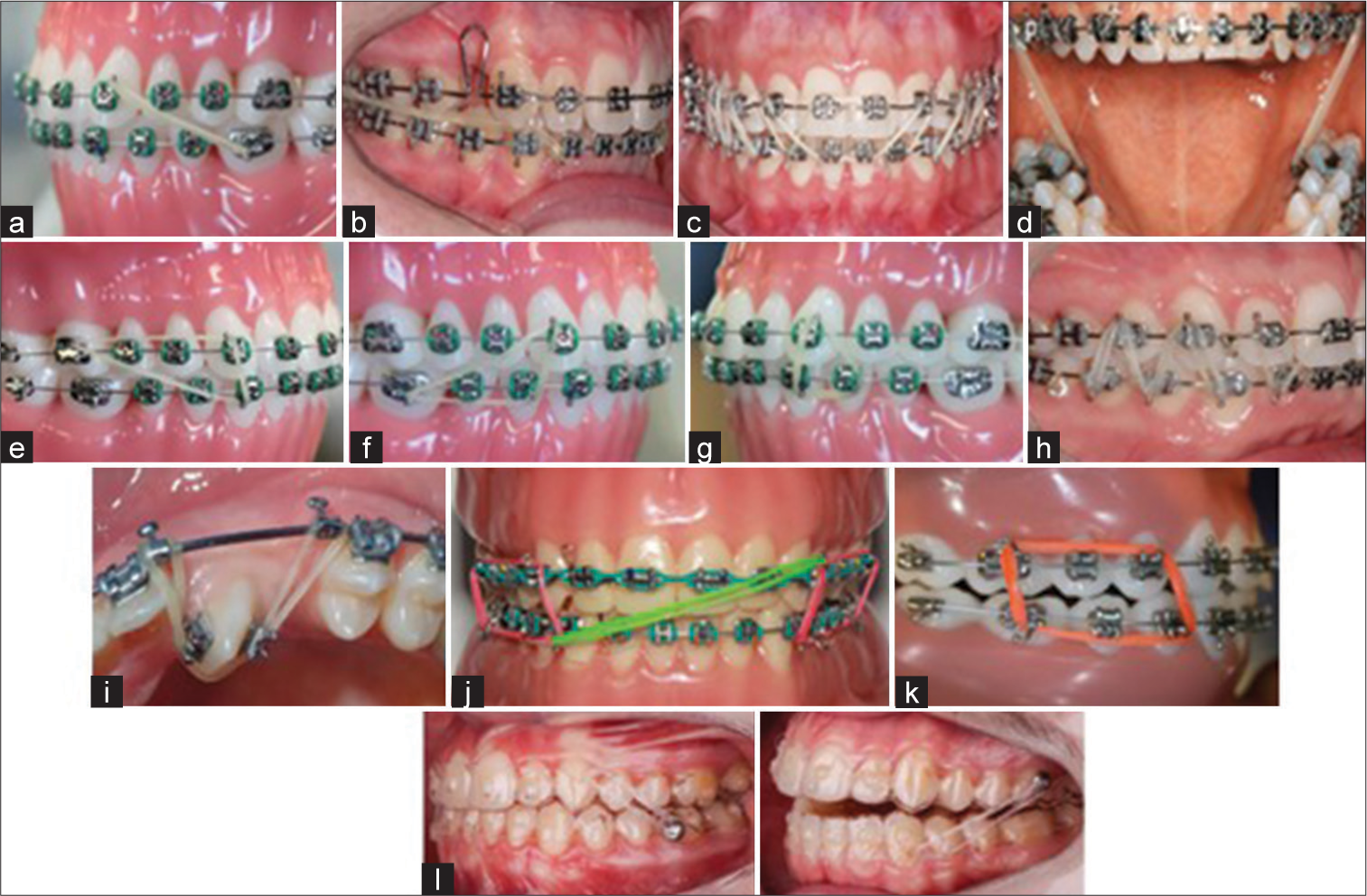 (a) Class II; (b) Class III; (c) anterior elastics; (d) cross elastics; (e) triangular type 2; (f) triangular type 3; (g) delta; (h) m elastics; (i) sling shot; (j) midline; (k) box elastics; and (l) intermaxillary elastics for aligners (modified from Farret, 2023).