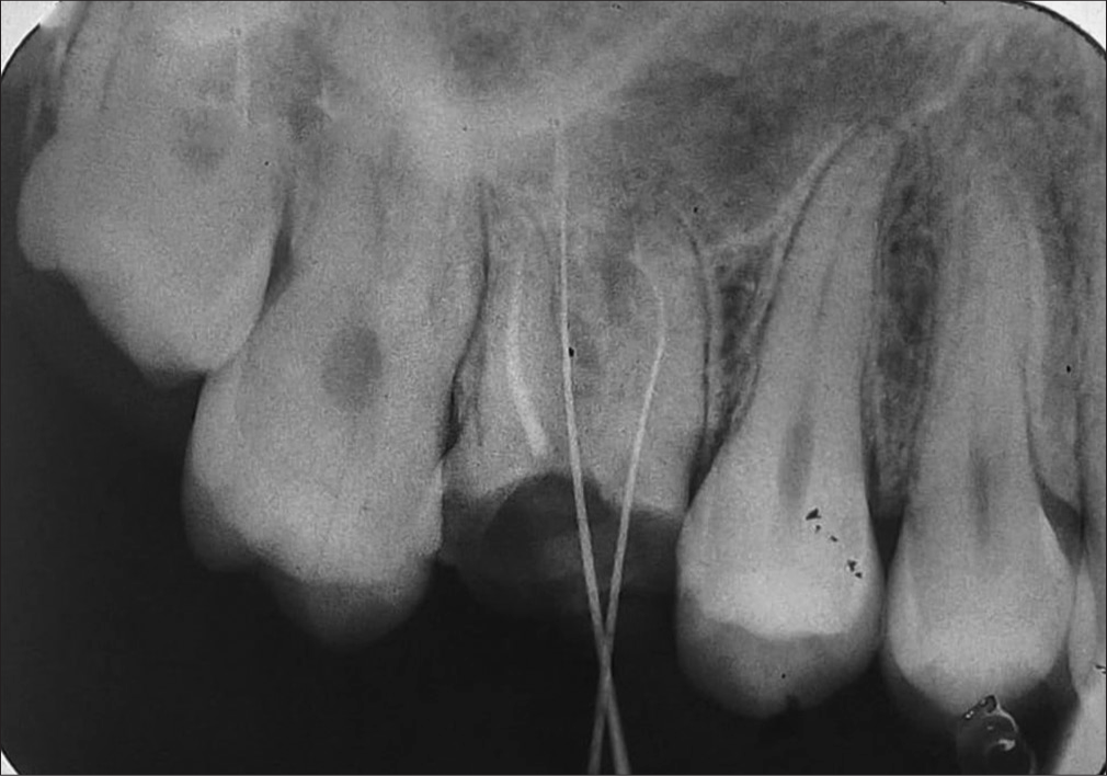 Retrieved gutta-percha 4–5 mm apical to seal from palatal and mesiobuccal canals.