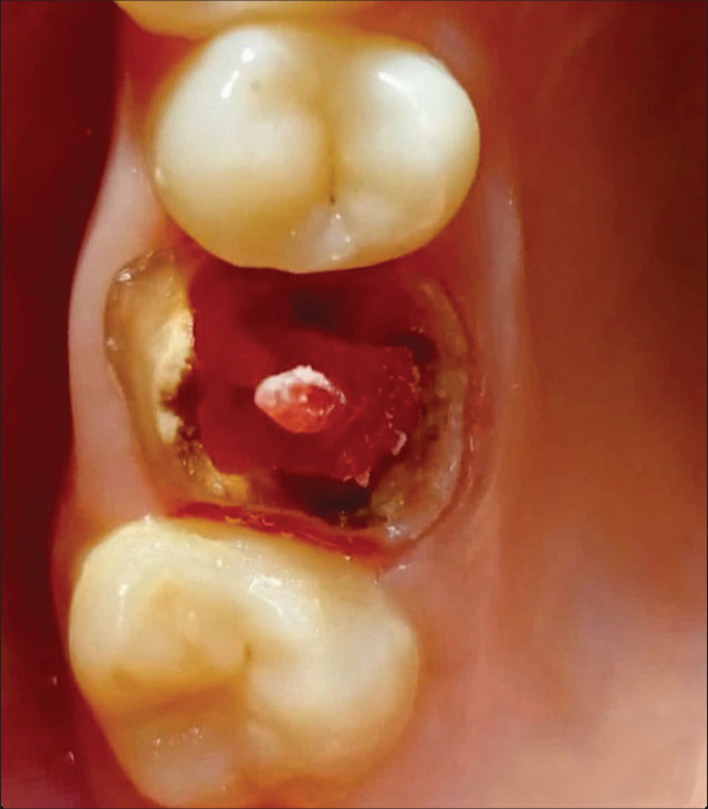 Palatal post pattern.