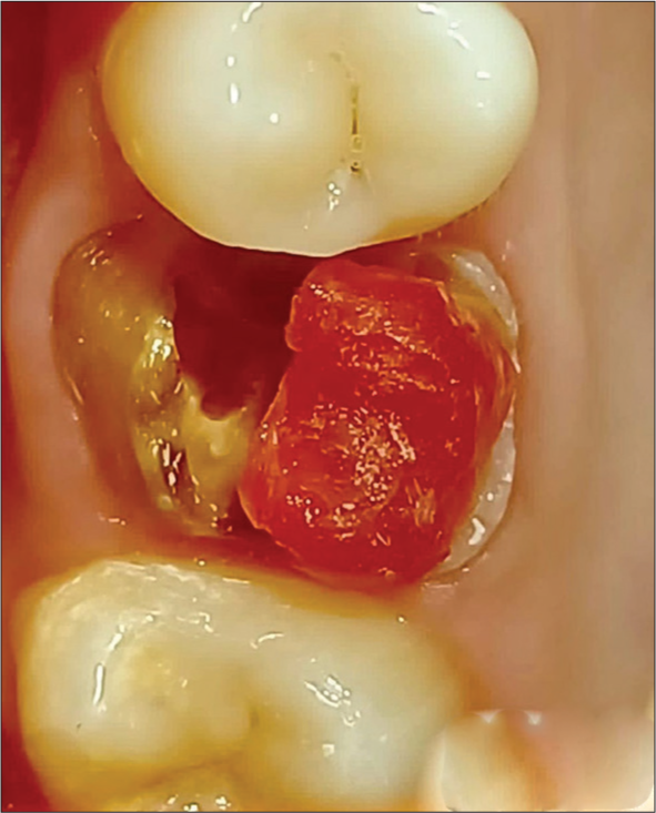 Palatal pattern core buildup.