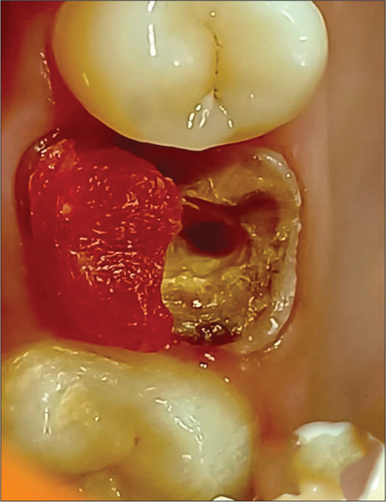 Buccal pattern core buildup.