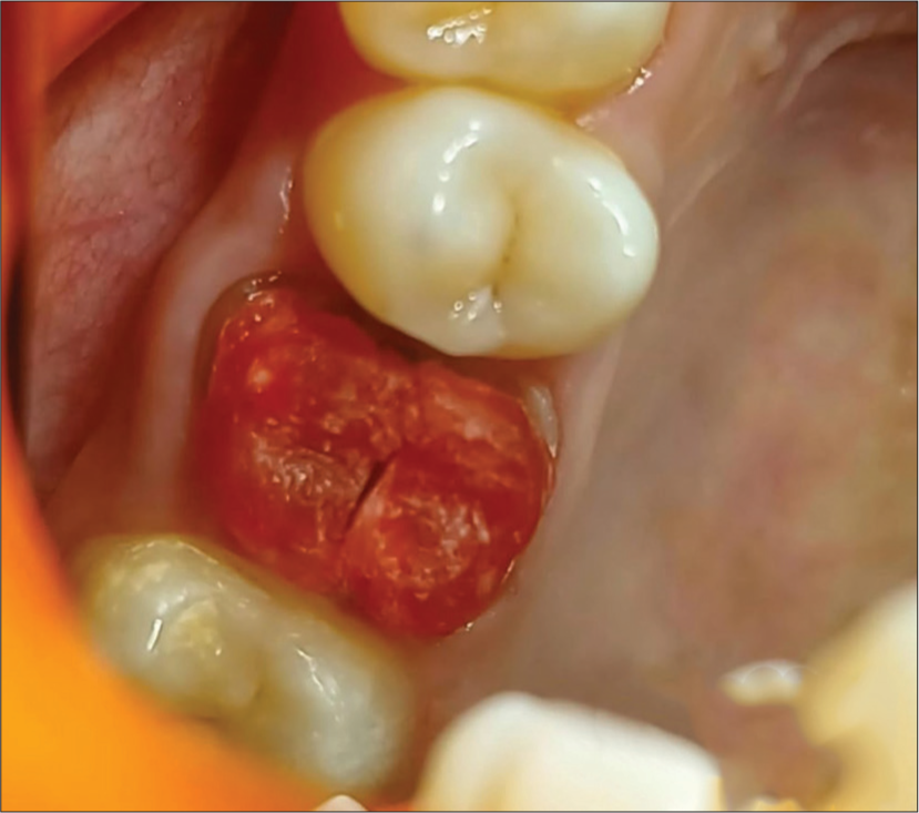 Approximation of buccal and palatal post and core buildups.