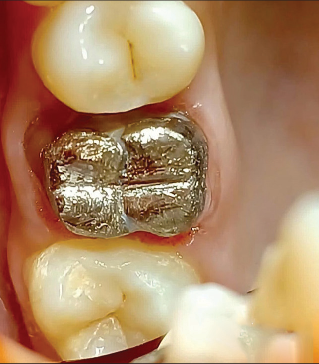 Cementation of cast metal post and core.