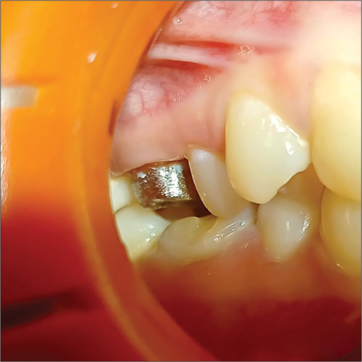 Occlusal clearance for porcelain-fused-to-metal crown.