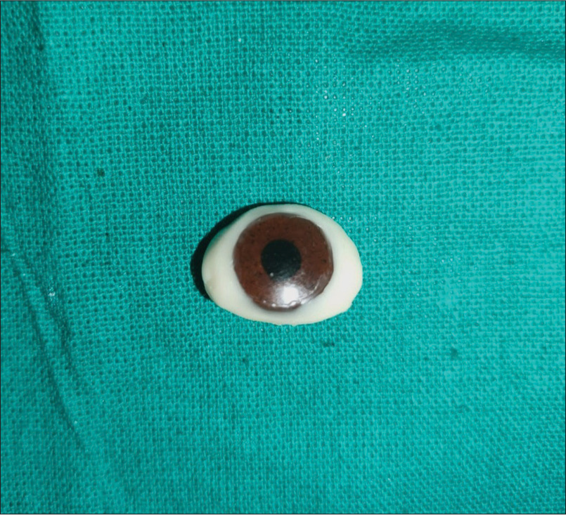 Stock iris positioned on the scleral wax pattern.