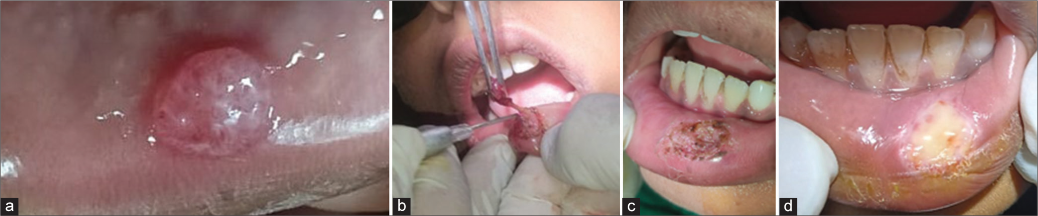 (a) A 10-year-old boy with mucocele in the left side of lower lip, (b) diode laser-assisted excision of the mucocele, (c) immediate post-operative photograph after the excision of the mucocele, (d) post-operative photograph of follow-up after one week during the healing phase.