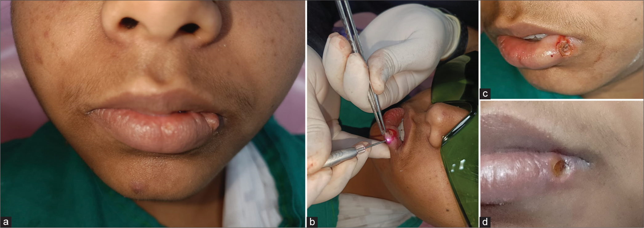 (a) An 18-year-old girl with mucocele in the left side of lower lip, (b) Diode laser-assisted excision of the mucocele, (c) immediate post-operative photograph after the excision of the mucocele, (d) post-operative photograph of follow-up after one week during the healing phase.