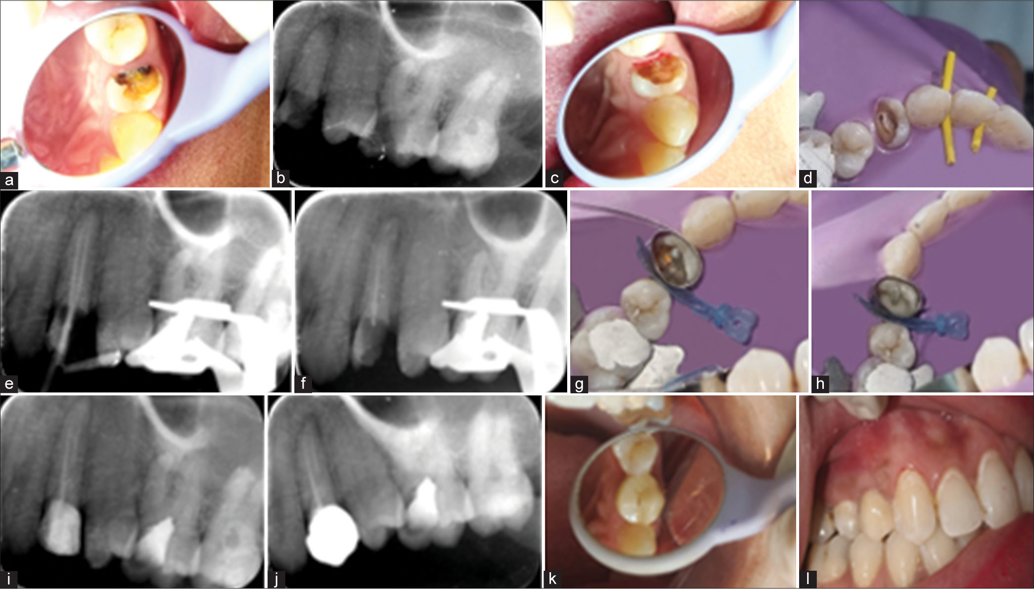 (a) Pre-operative clinical image, (b) pre-operative radiograph, (c) subgingival marginal after caries removal, (d) access opening, (e) master cone radiograph, (f) obturation (section obturation in palatal), (g) modified matrix system for isolation, (h) fiber post luting and margin elevation done, (i) radiograph after margin elevation. (j) post-operative radiograph, (k) post-operative clinical image, and (l) follow-up clinical image showing healthy periodontium.