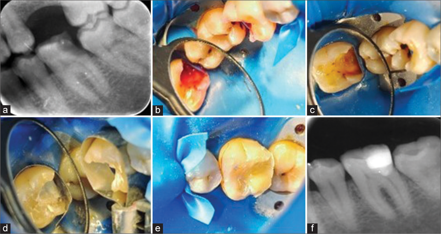 (a) Pre-operative radiograph, (b) application of caries detection dye, and (c) after complete caries removal, pinpoint pulpal exposure was seen along with subgingival margin. (d) MTA was placed at the exposure site, followed by marginal elevation done using RMGIC, (e) composite restoration done, and (f) post-operative radiograph. MTA: mineral trioxide; RMGIC: resin-modified glass ionomer cement.