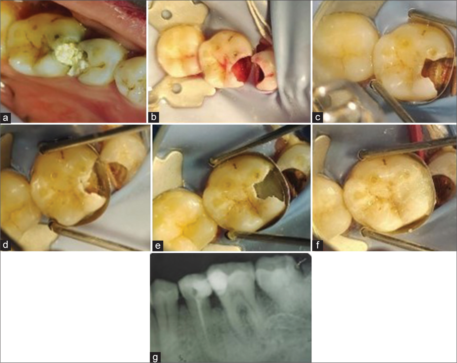 (a) Pre-operative clinical image, (b) application of caries detection dye, and (c) on complete caries removal subgingival margin was seen with respect to 46. (d) Indirect pulp capping using MTA, (e) margin elevation done using RMGIC, (f) composite restoration done, and (g) post-operative radiograph showing endodontic treatment with respect to 45 and deep margin elevation followed by direct restoration with respect to 46. MTA: mineral trioxide; RMGIC: resin-modified glass ionomer cement.