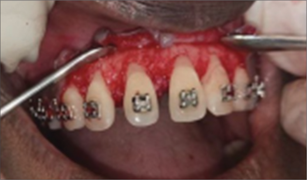 Elevation of full-thickness mucoperiosteal flap.