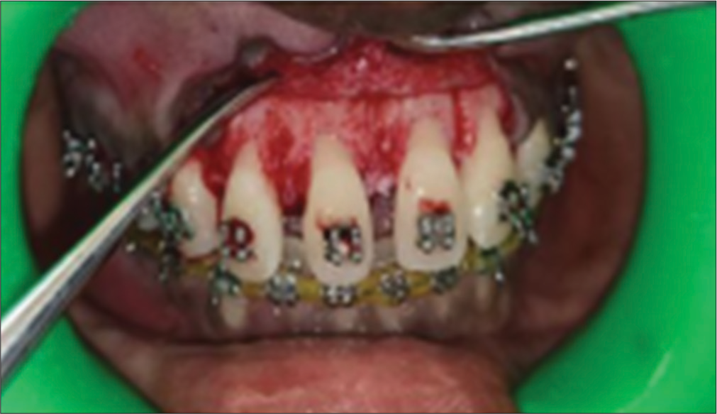 Vertical slits prepared up to 1–1.5-mm depth at mesial and distal line angle of the root.