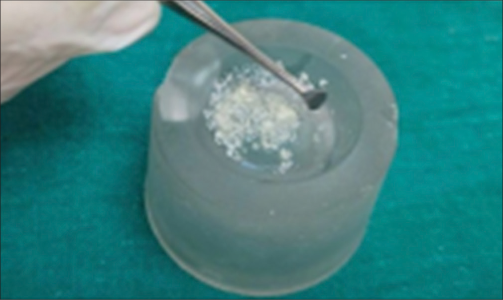 Prepared bone graft (ColoGenesis Colocast bone graft).