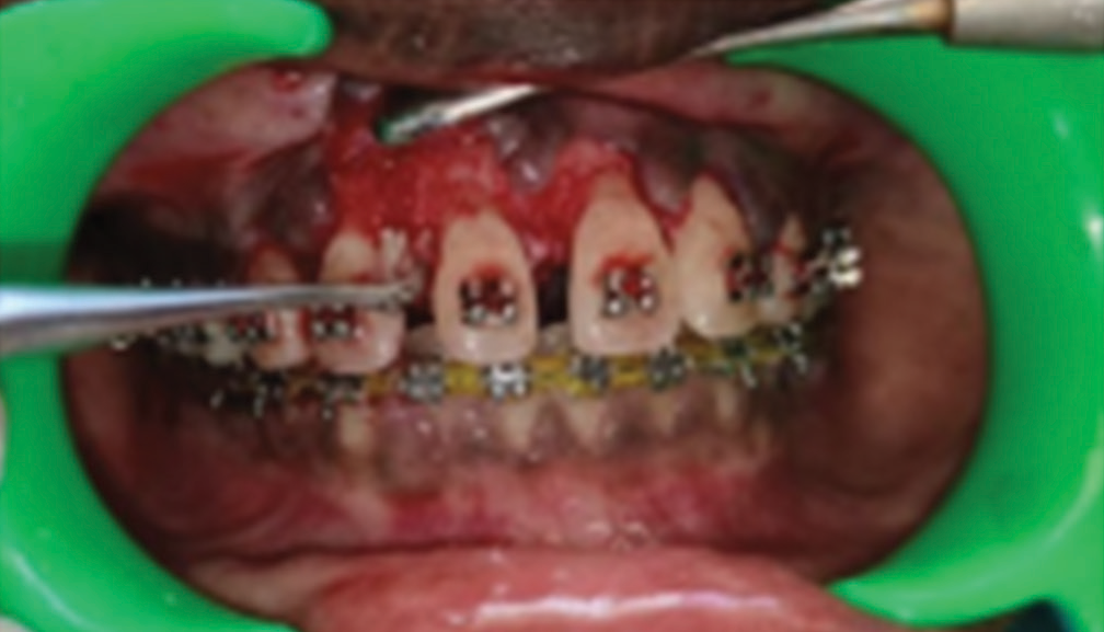 Placement of allograft (ColoGenesis Colocast bone graft).