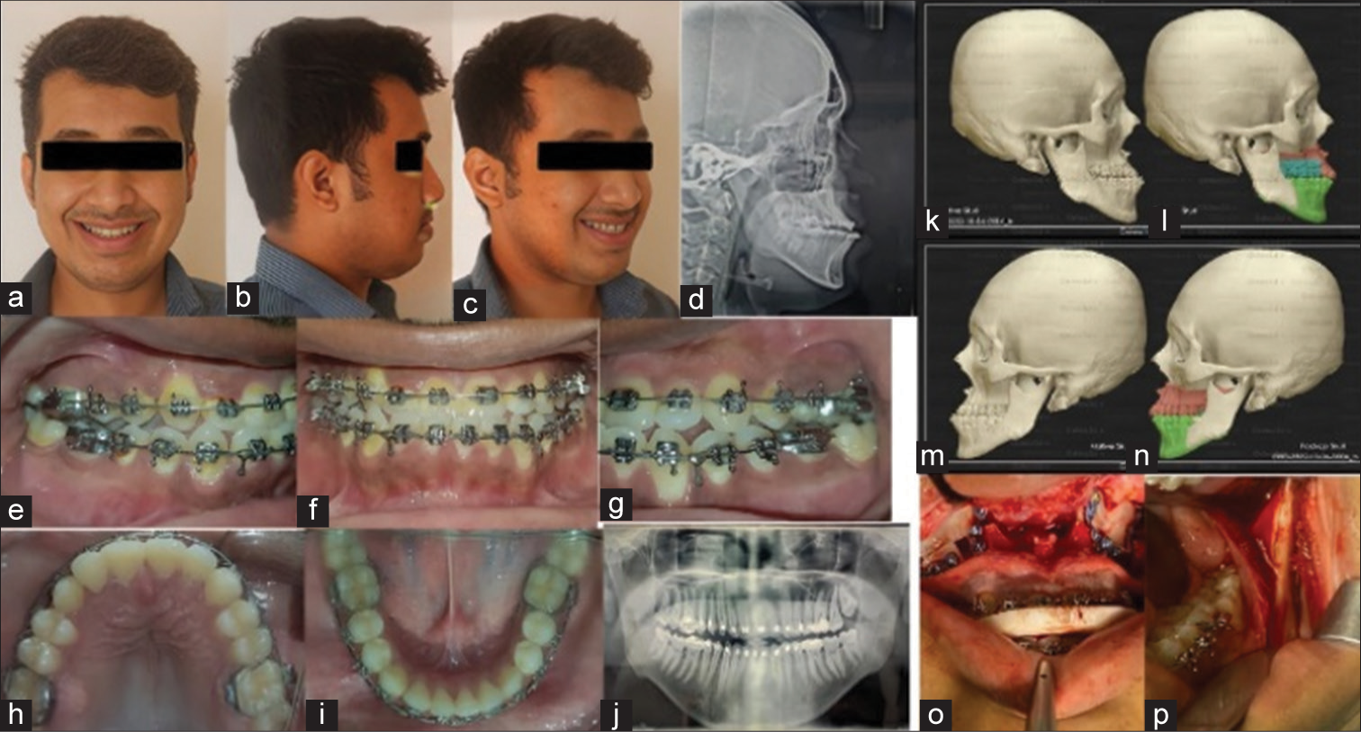 Pre-treatment (a-c) extraoral, (d) lateral cephalogram, (e-i) intraoral photographs, (j) orthopantomogram, (k-n) three-dimensional surgical planning, and (o-p) intraoral photographs during surgery.