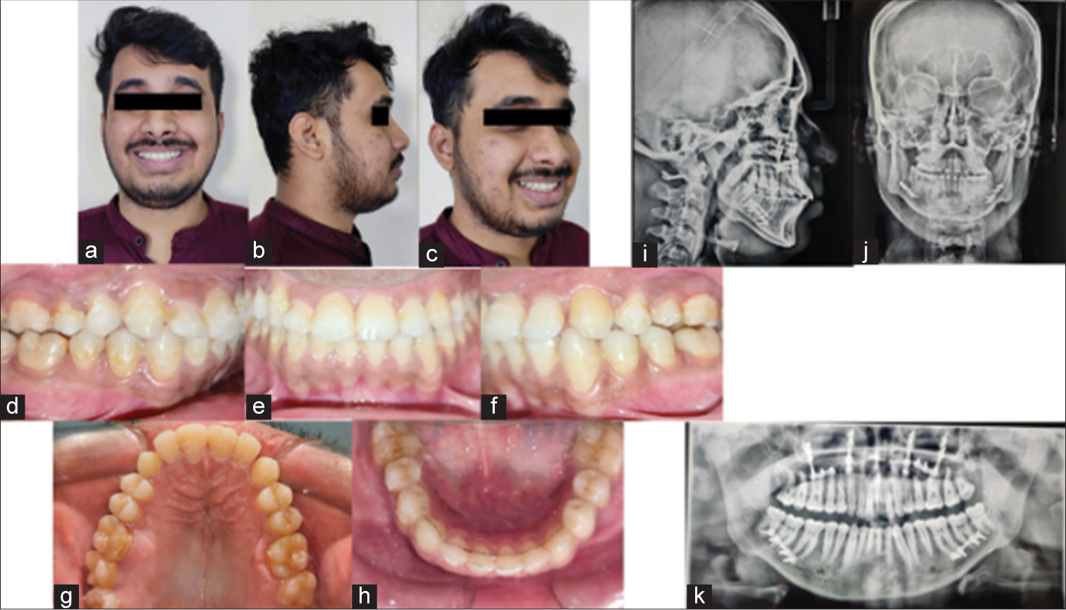 Post-treatment (a-c) extraoral and (d-h) intraoral photographs, (i) lateral cephalogram, (j) posteroanterior cephalogram, and (k) orthopantomogram.