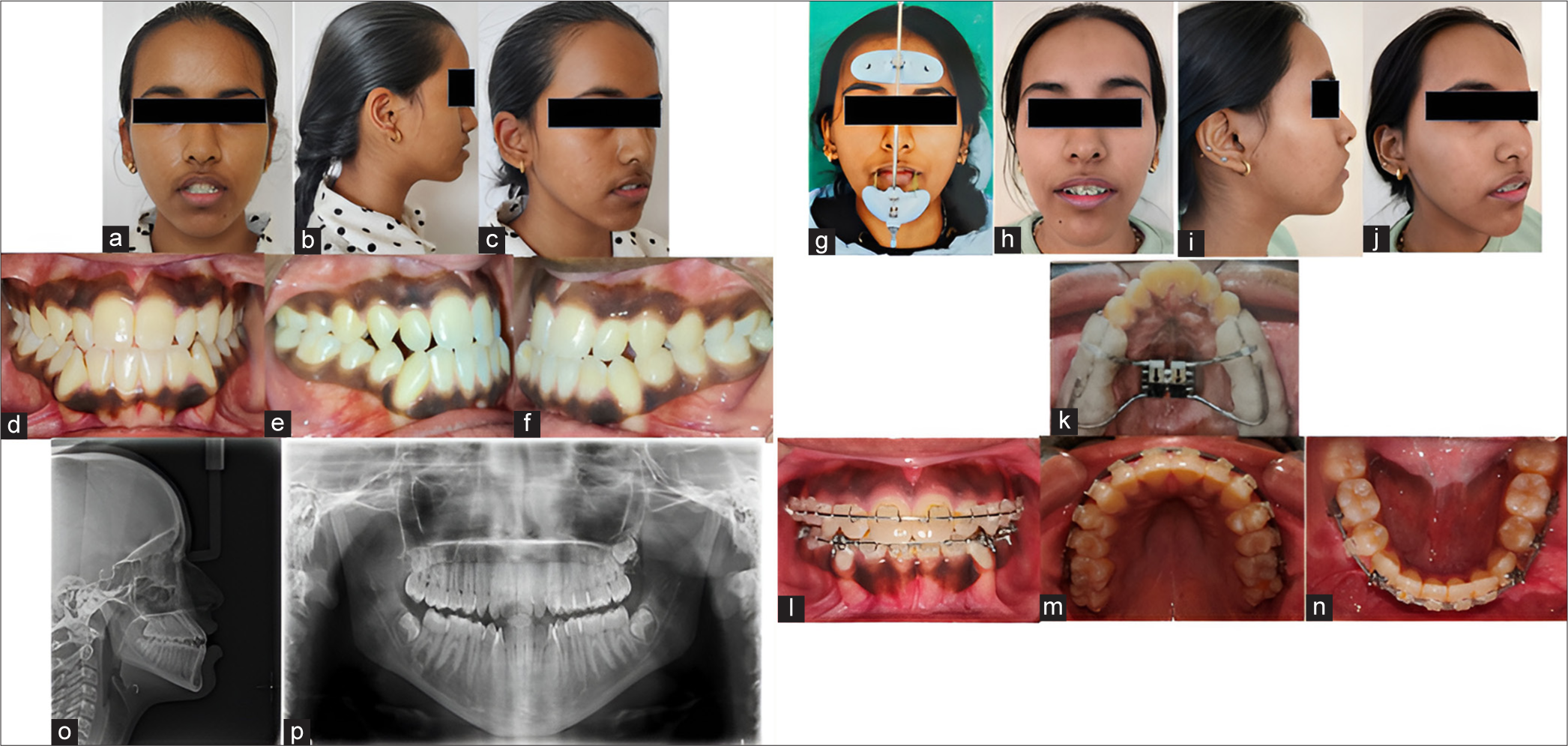 Pre-treatment (a-c) extraoral and (d-f) intraoral photographs, stage treatment (g-j) extraoral and (k-n) intraoral photograph, (o) lateral cephalogram, and (p) orthopantomogram.