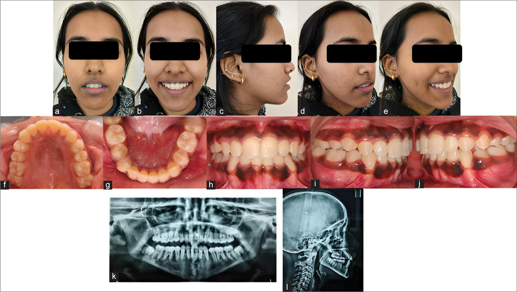 Post-treatment (a-e) extraoral and (f-j) intraoral photographs, (k) orthopantomogram, and (l) lateral cephalogram.