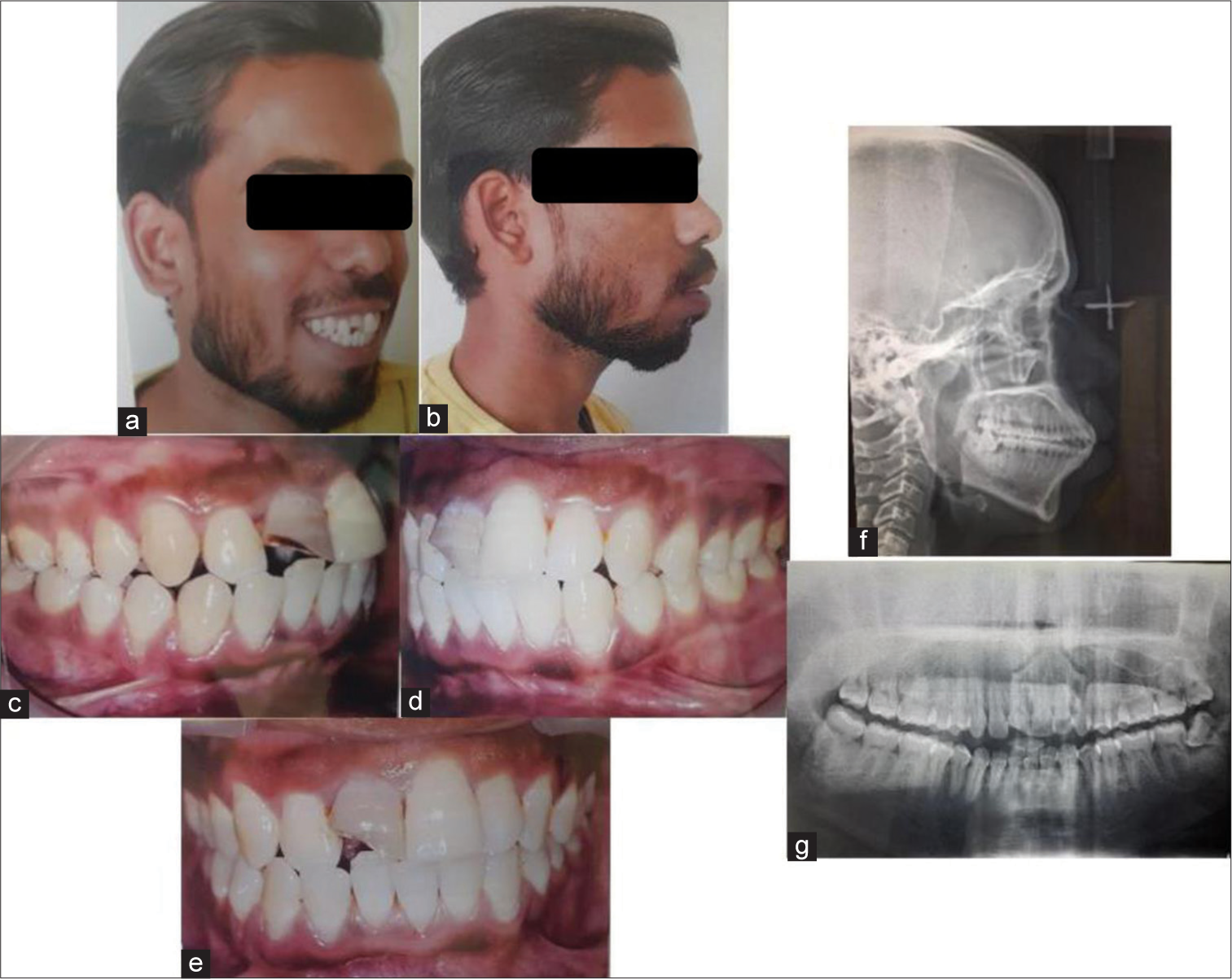 Pre-treatment (a-b) extraoral and (c-e) intraoral photographs, (f) lateral cephalogram, and (g) orthopantomogram.