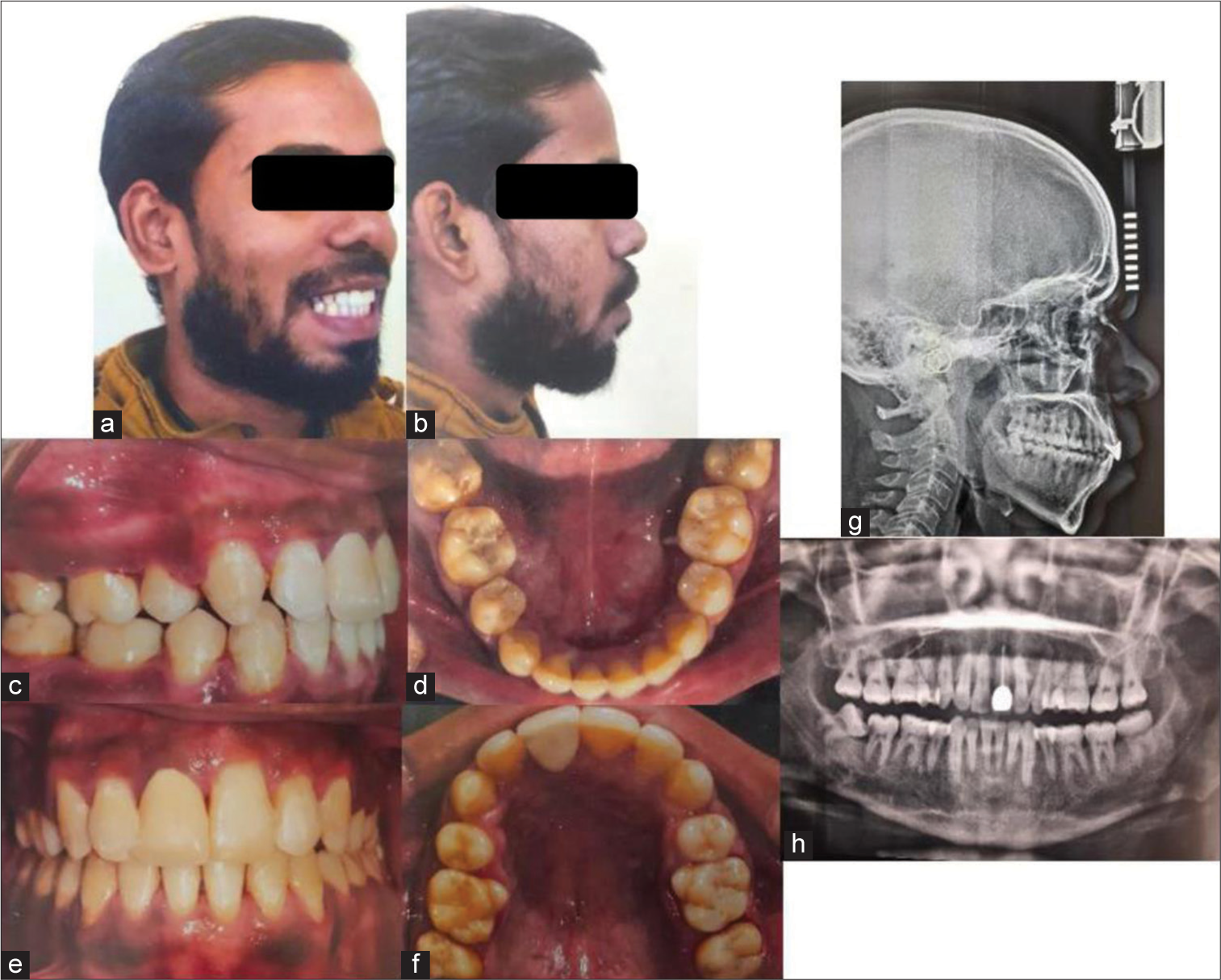 Post-treatment (a-b) extraoral and (c-f) intraoral photographs, (g) lateral cephalogram, and (h) orthopantomogram.