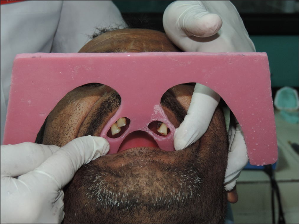Customized occlusal plane device in position.