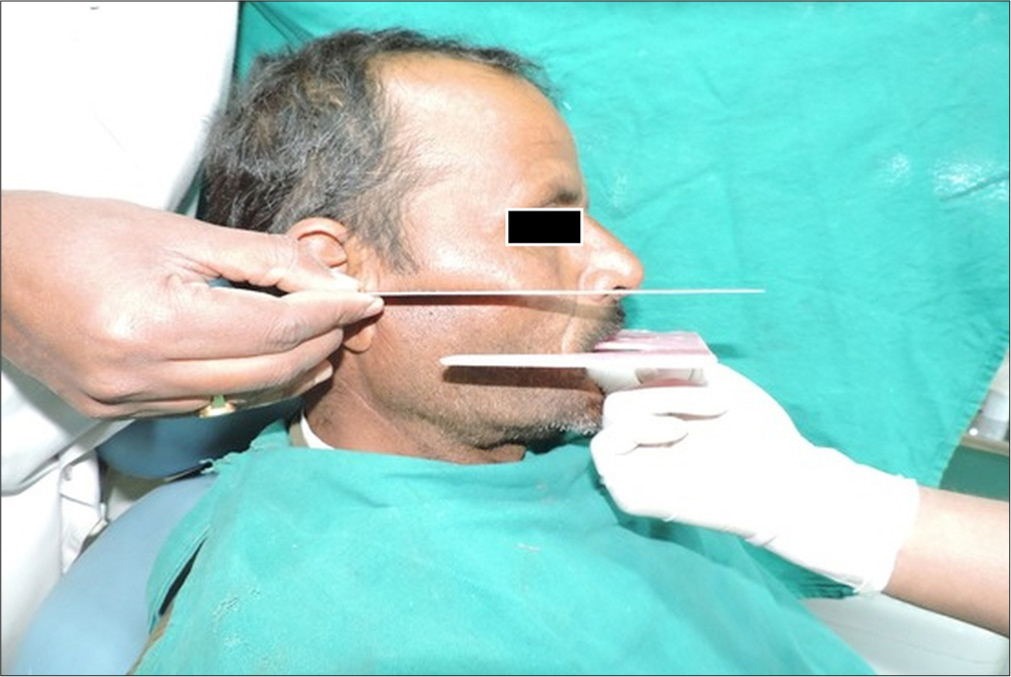 Assessment of parallelism of occlusal plane to camper’s plane.