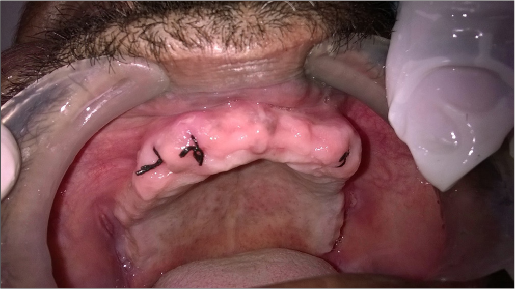 Extraction of remaining dentition.